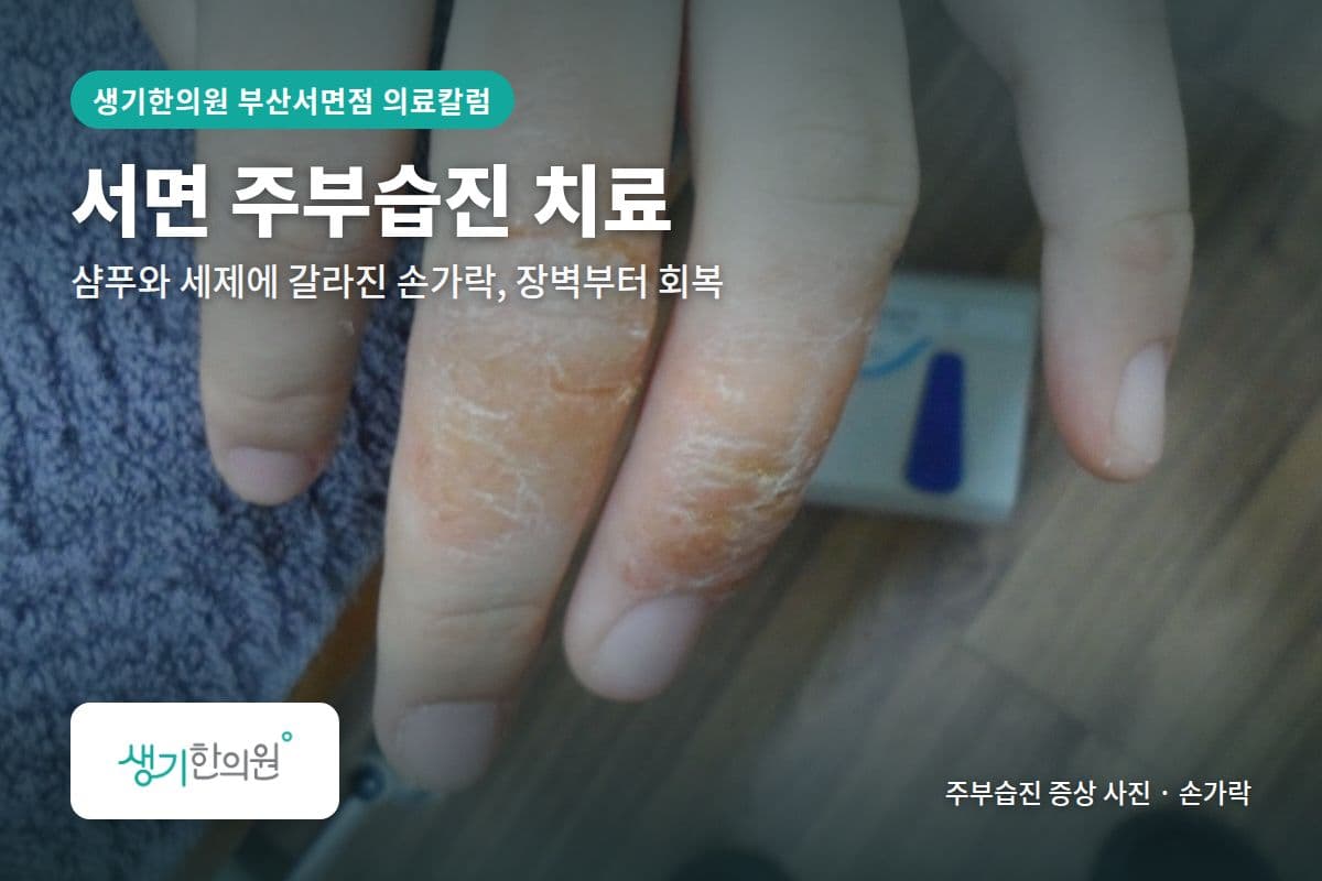 손가락 주부습진 증상 사진과 문구 「서면 주부습진 치료, 샴푸와 세제에 갈라진 손가락, 장벽부터 회복 · 생기한의원 부산서면점」
