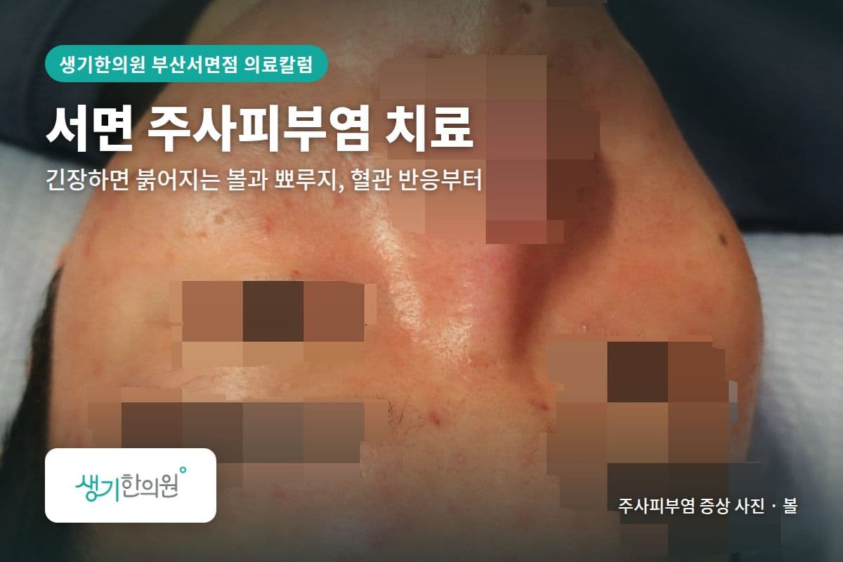 볼 주사피부염 증상 사진과 문구 「서면 주사피부염 치료, 긴장하면 붉어지는 볼과 뾰루지, 혈관 반응부터 · 생기한의원 부산서면점」