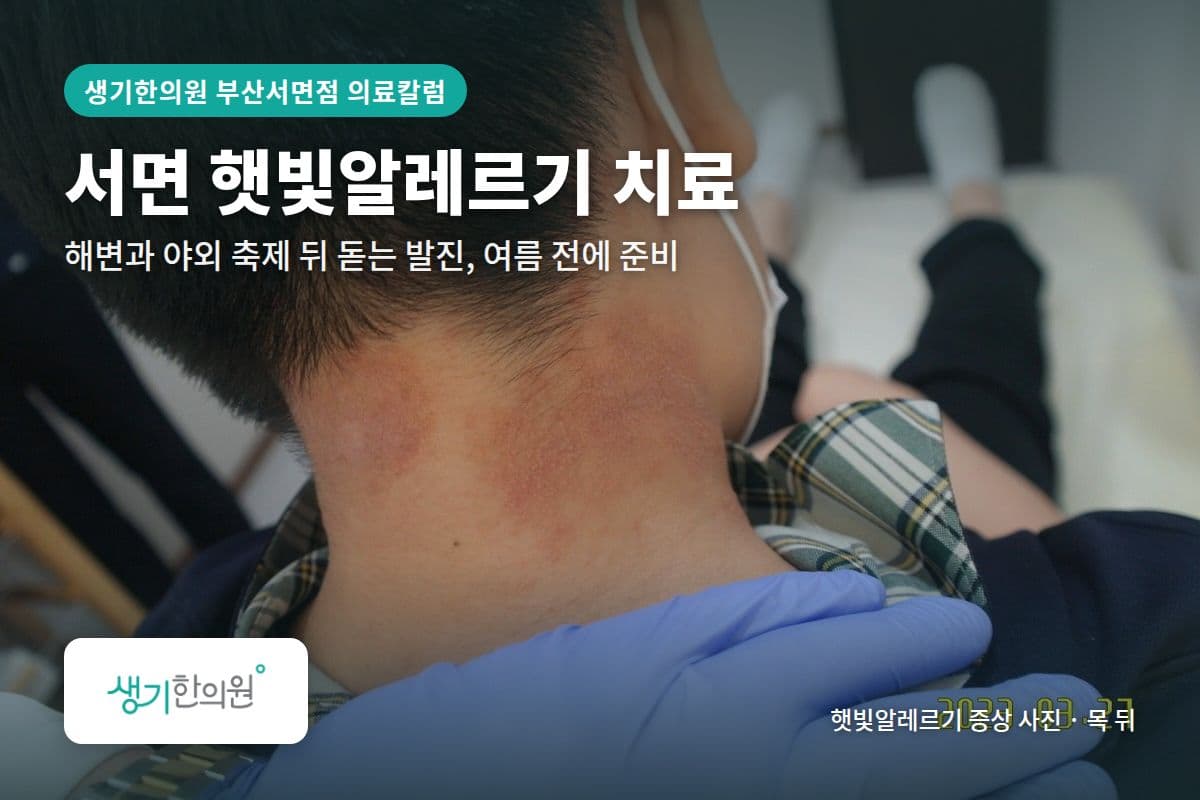 목 뒤 햇빛알레르기 증상 사진과 문구 「서면 햇빛알레르기 치료, 해변과 야외 축제 뒤 돋는 발진, 여름 전에 준비 · 생기한의원 부산서면점」