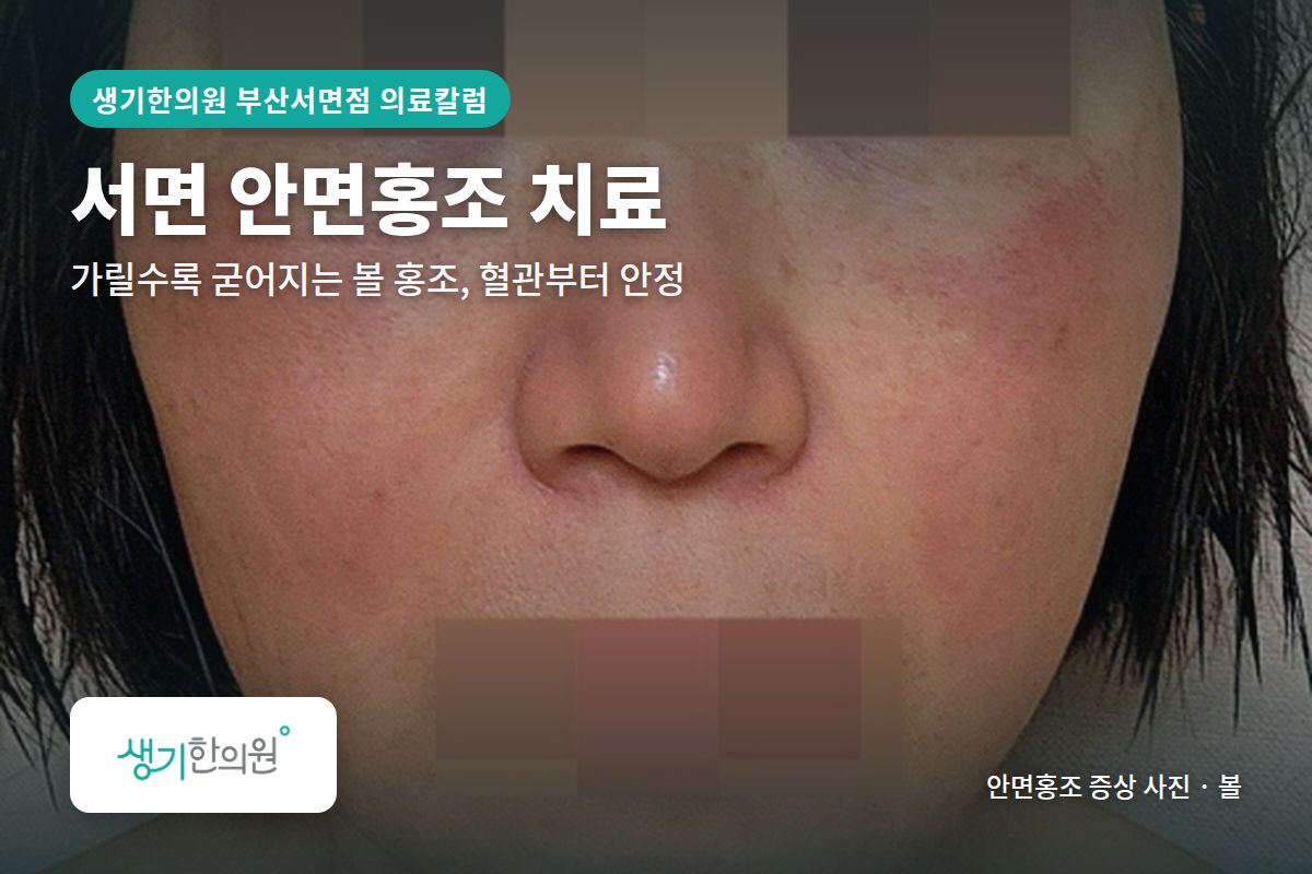 볼 안면홍조 증상 사진과 문구 「서면 안면홍조 치료, 가릴수록 굳어지는 볼 홍조, 혈관부터 안정 · 생기한의원 부산서면점」